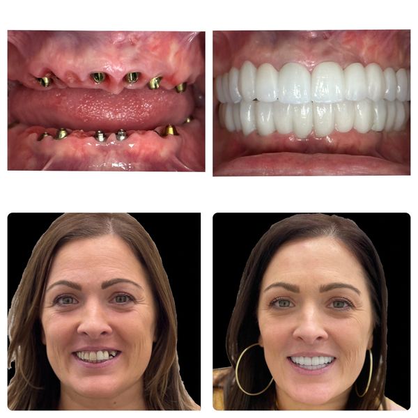 Illustrative example of 3 on 6 dental implants from Google Search