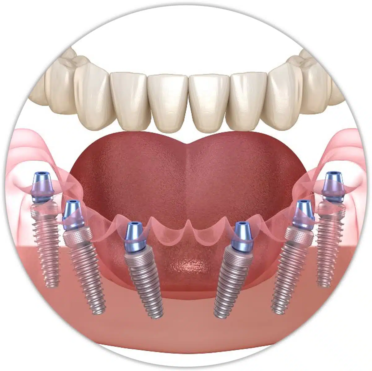 Illustrative example of 3 on 6 dental implants from Google Search