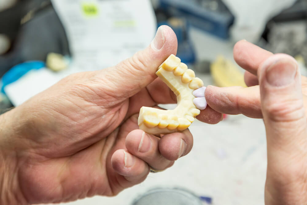 Illustrative example of 3d dental implants from Google Search
