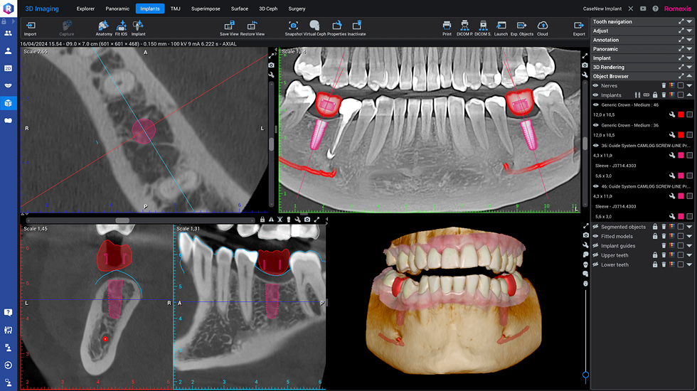 Illustrative example of 3d dental implants from Google Search