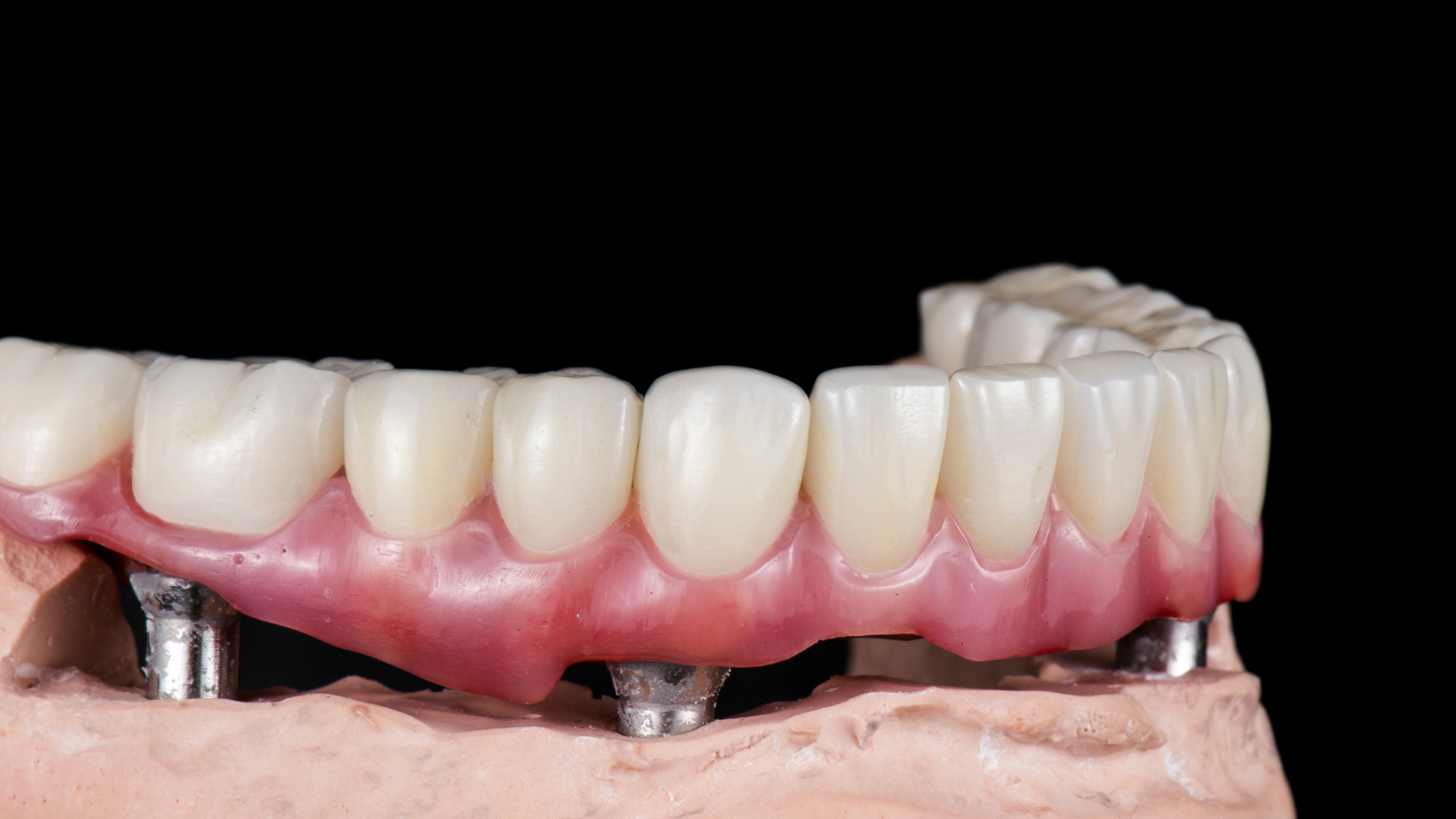 Illustrative example of 3d printed dental implants from Google Search