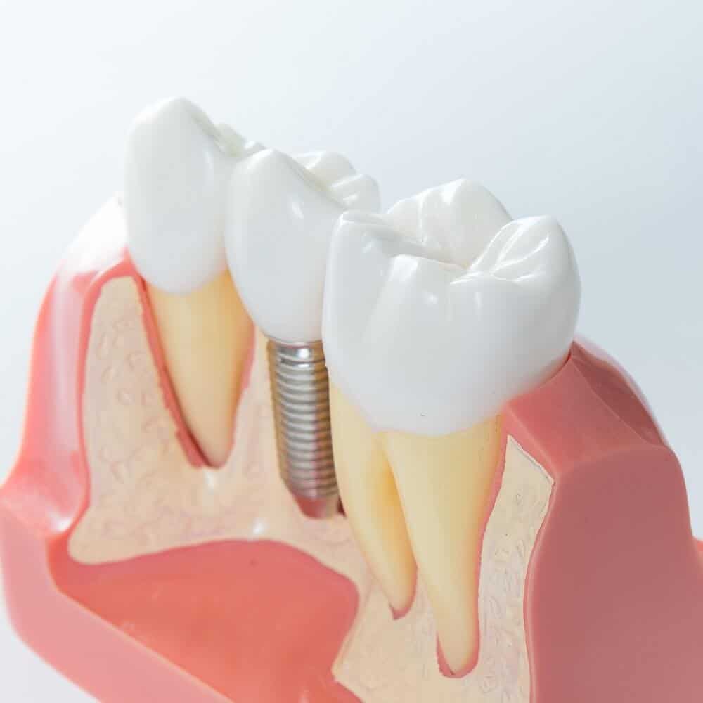 Illustrative example of 3i dental implants from Google Search