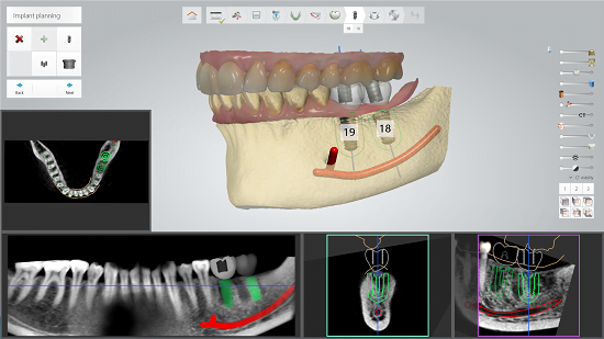 Illustrative example of 3i dental implants from Google Search