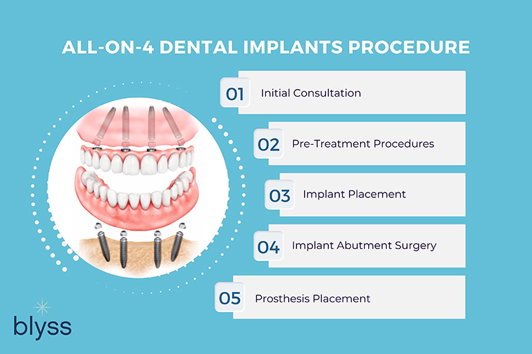 Illustrative example of 4 in all dental implants from Google Search