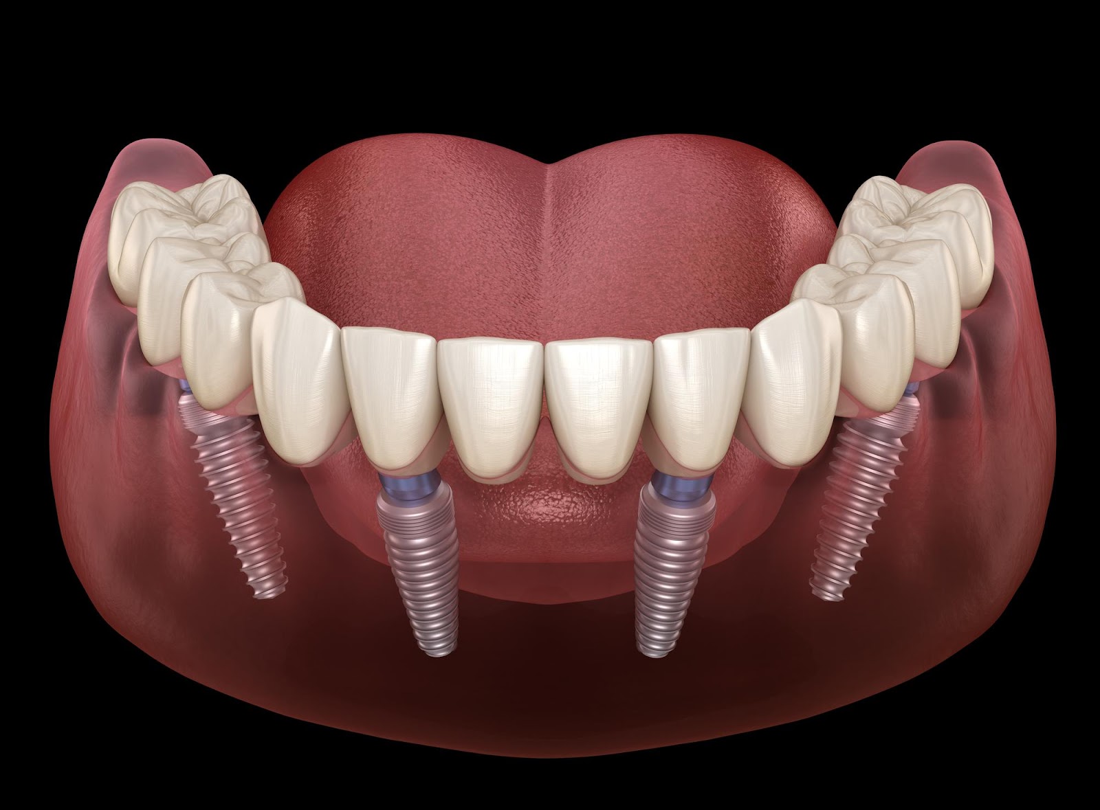 Illustrative example of 4 in all dental implants from Google Search