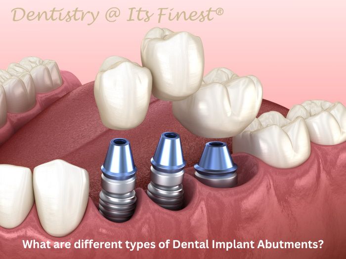 Illustrative example of abutments for dental implants from Google Search