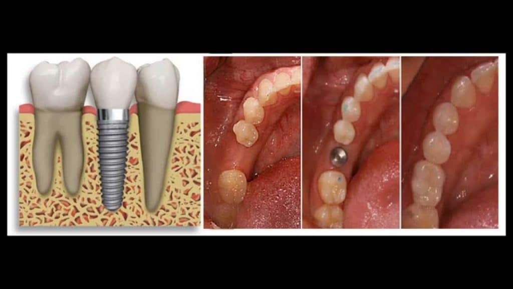 Illustrative example of algodones dental implants from Google Search