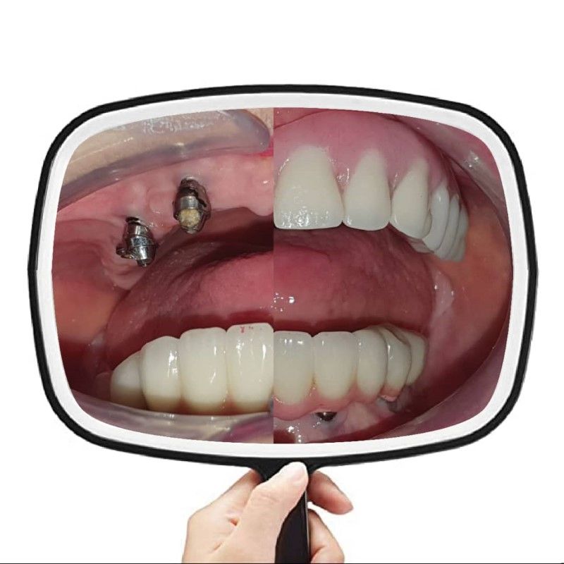 Illustrative example of algodones dental implants from Google Search