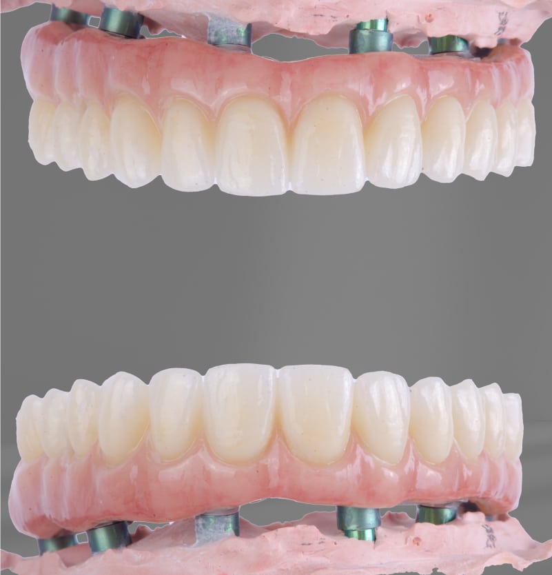 Illustrative example of all in one dental implants from Google Search