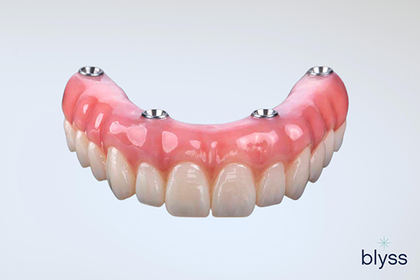 Illustrative example of all in one dental implants from Google Search