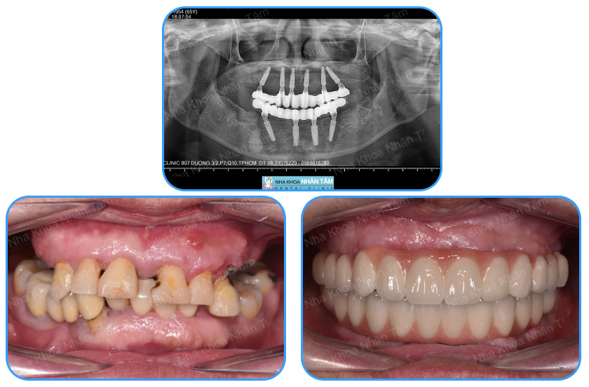 Illustrative example of all in six dental implants from Google Search