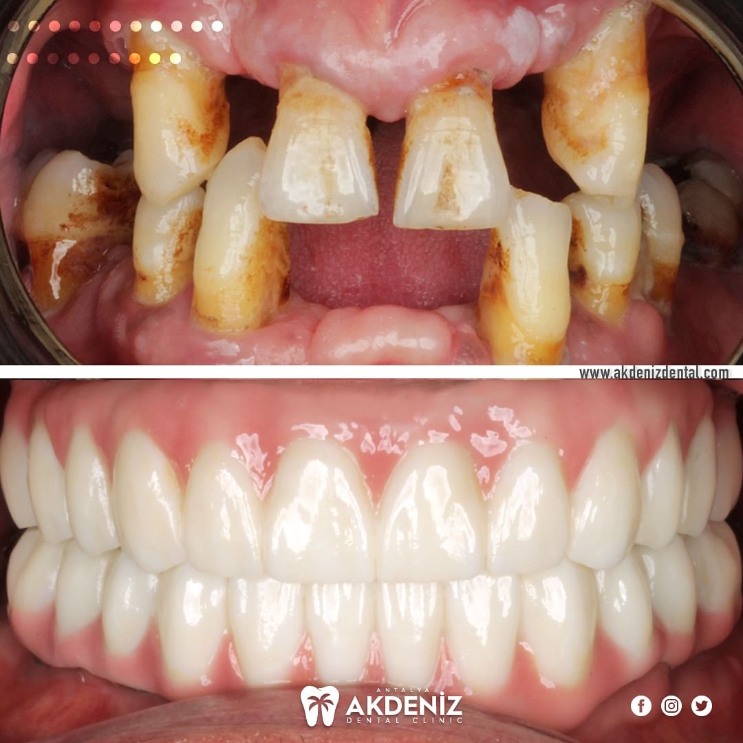 Illustrative example of all in six dental implants from Google Search