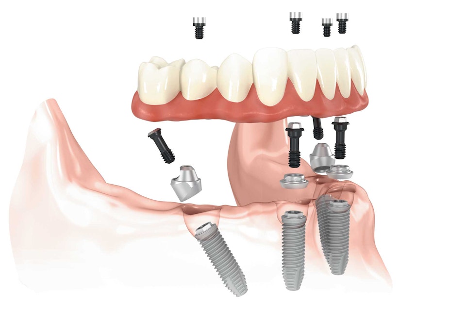 Illustrative example of all on 4 dental implants financing from Google Search