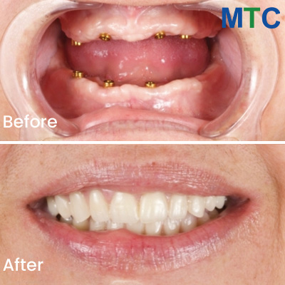 Illustrative example of all on 4 dental implants mexico from Google Search