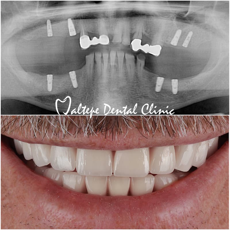 Illustrative example of all on 4 dental implants zirconia from Google Search