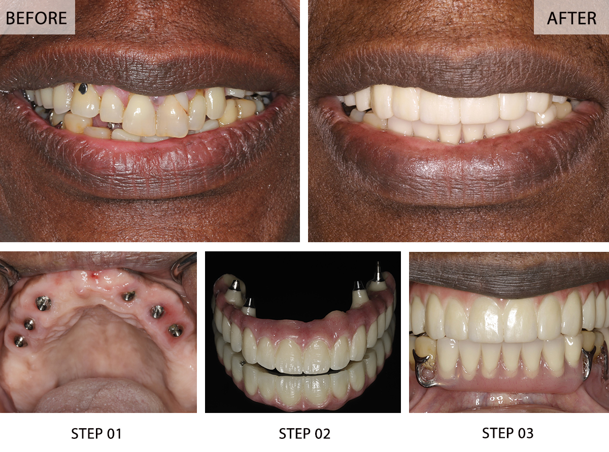 Illustrative example of all on 6 dental implants before and after from Google Search