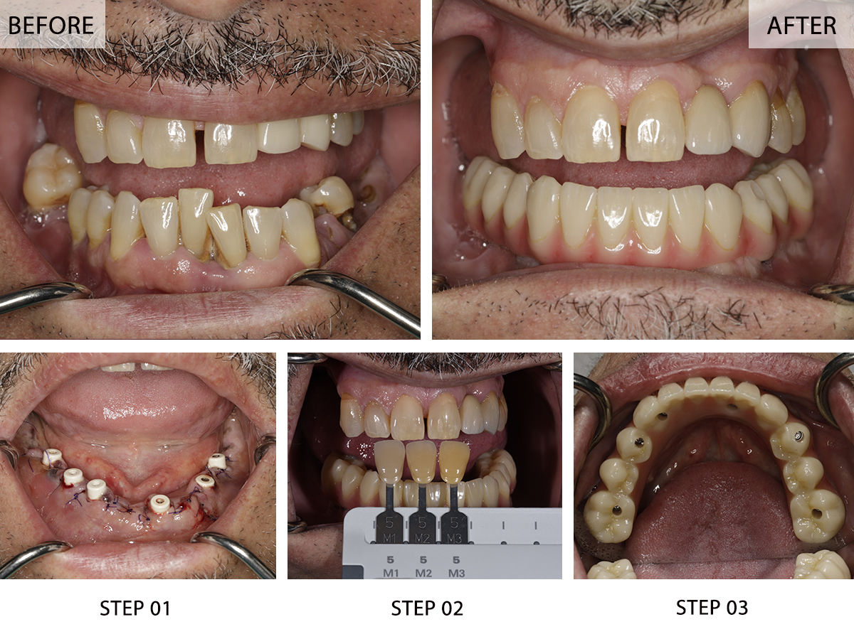 Illustrative example of all on 6 dental implants before and after from Google Search