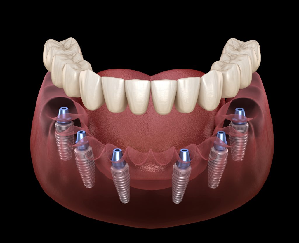 Illustrative example of all on 6 dental implants from Google Search