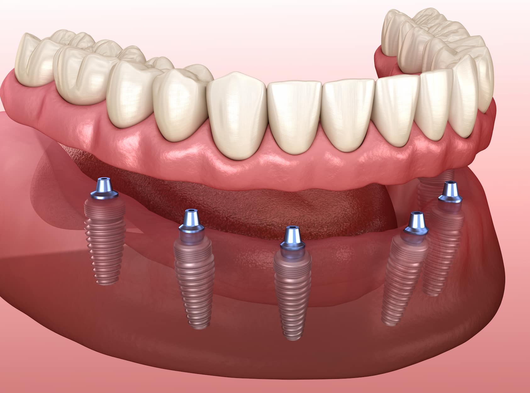 Illustrative example of all on 6 dental implants from Google Search