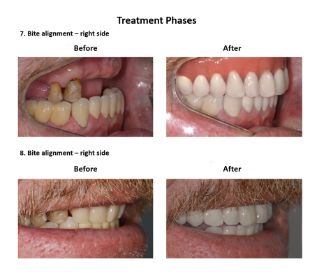 Illustrative example of all on 8 dental implants from Google Search