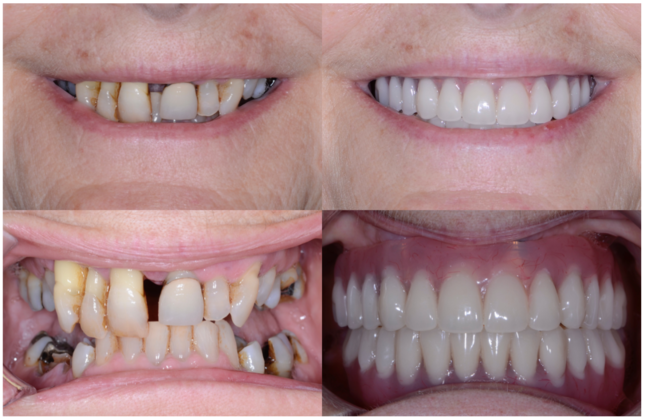 Illustrative example of all on four dental implants reviews from Google Search