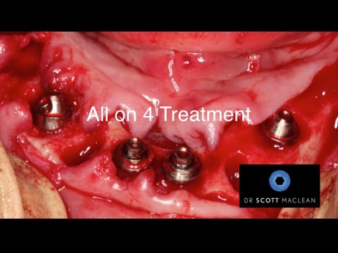 Illustrative example of all on four dental implants video from Google Search