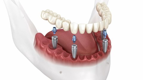 Illustrative example of all on four dental implants video from Google Search