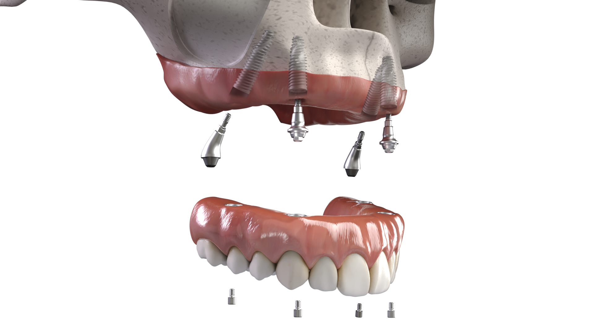 Illustrative example of all on x dental implants from Google Search