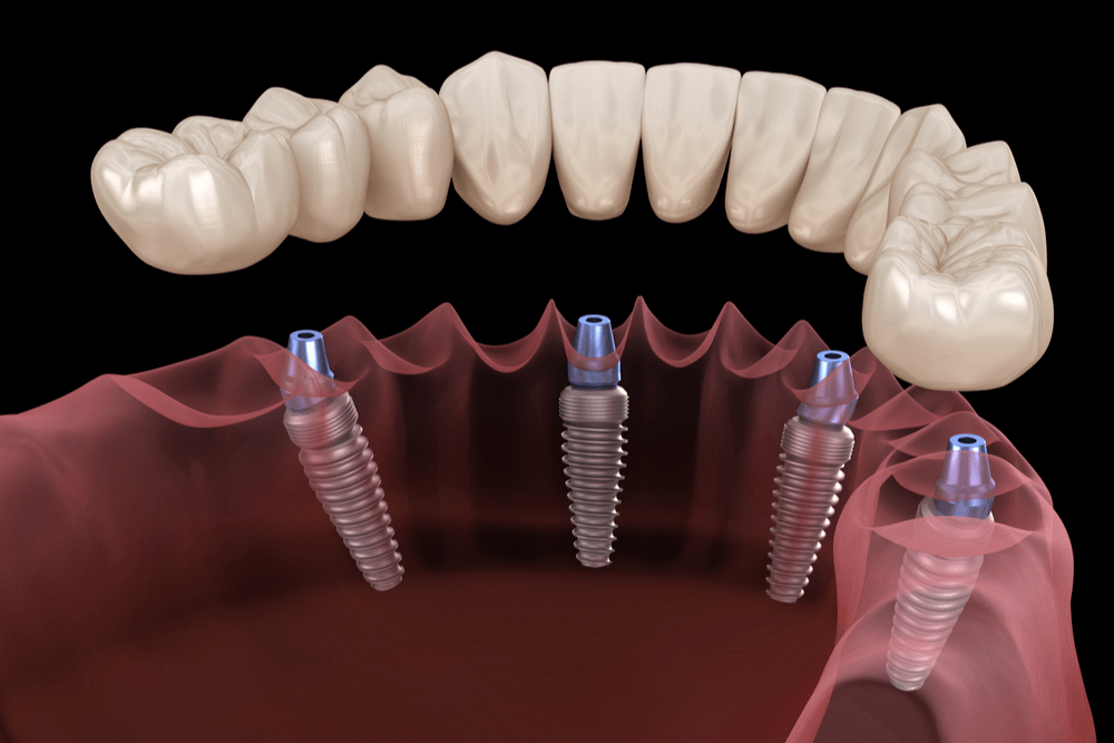 Illustrative example of all on x dental implants from Google Search