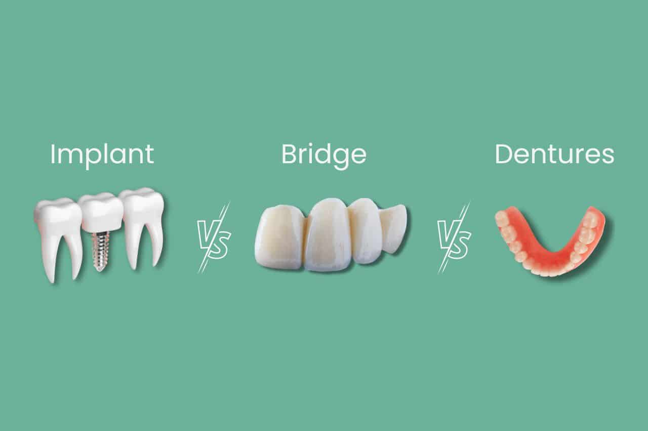 Illustrative example of alternative to dental implants from Google Search