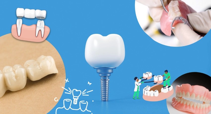 Illustrative example of alternative to dental implants from Google Search