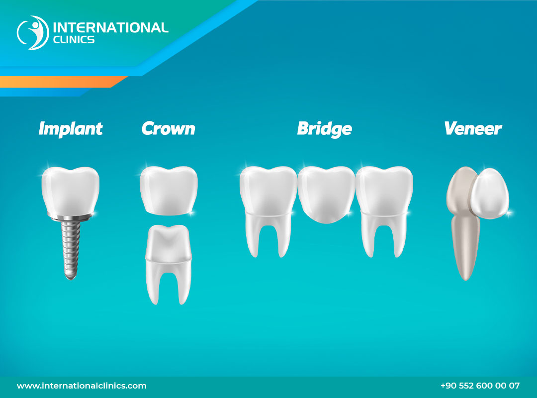 Illustrative example of alternatives to dental implants from Google Search