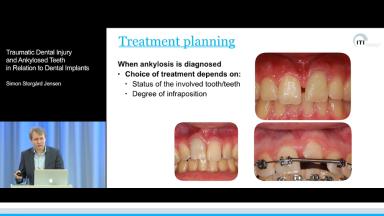 Illustrative example of ankylosis dental implants from Google Search