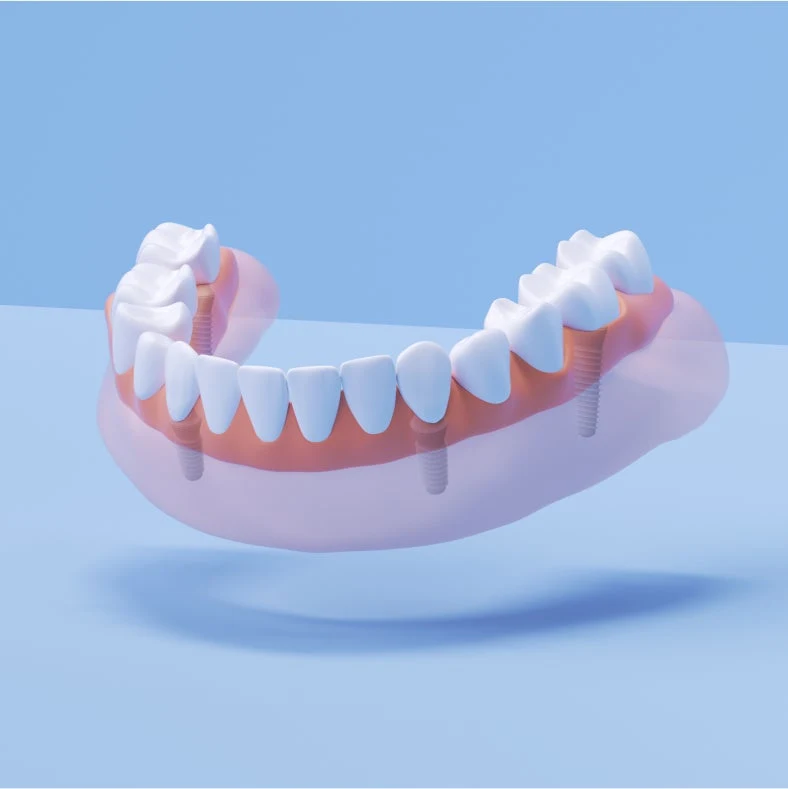 Illustrative example of arch dental implants from Google Search