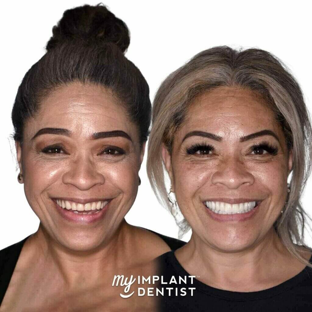 Illustrative example of before and after dental implants from Google Search