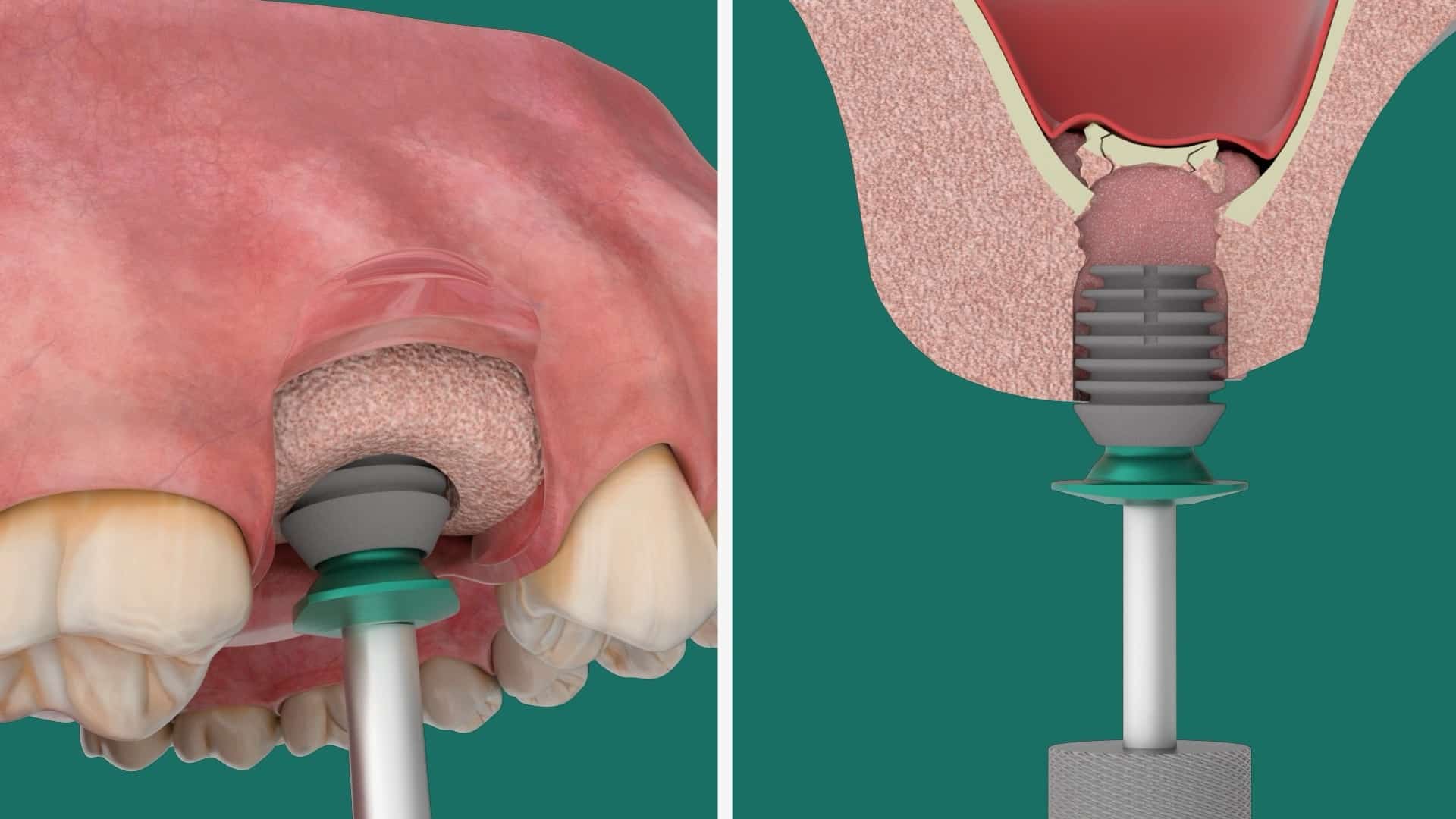 Illustrative example of bicon dental implants from Google Search
