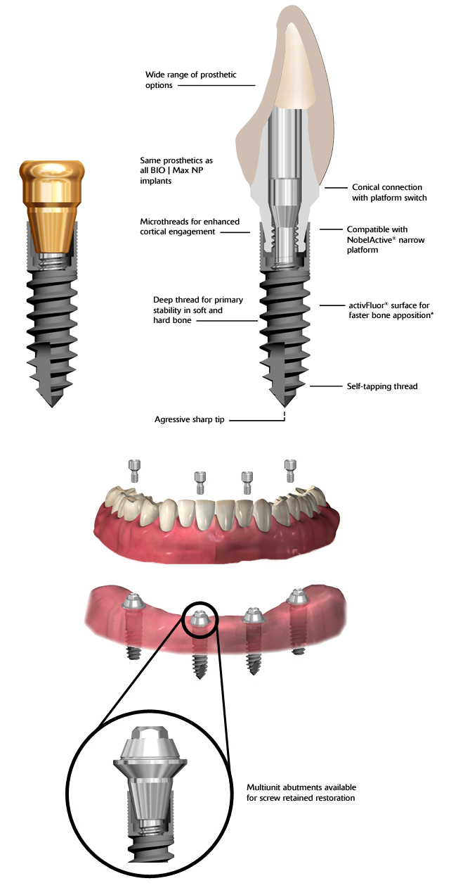 Illustrative example of blue sky bio dental implants from Google Search