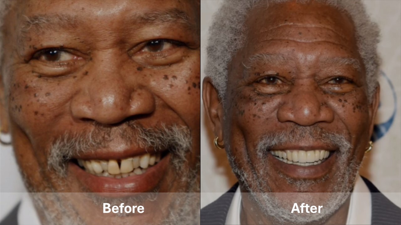 Illustrative example of celebrities with dental implants from Google Search