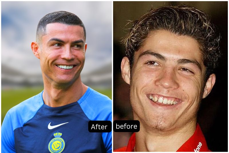 Illustrative example of celebrity dental implants before and after from Google Search