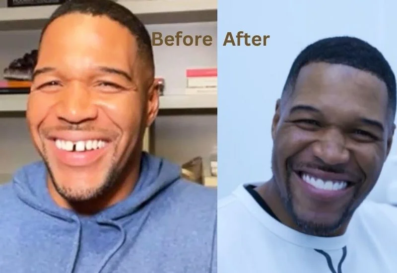 Illustrative example of celebrity dental implants before and after from Google Search