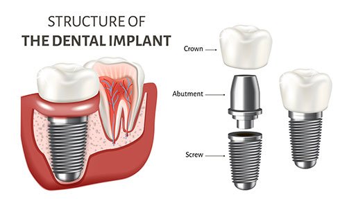 Illustrative example of ceramic dental implants from Google Search