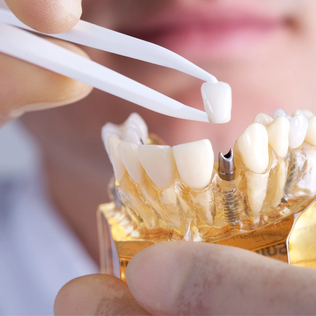 Illustrative example of cleaning dental implants from Google Search