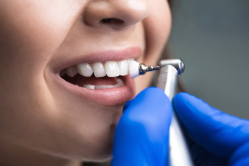 Illustrative example of cleaning dental implants from Google Search