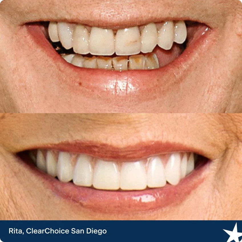 Illustrative example of clear choice dental implant reviews from Google Search
