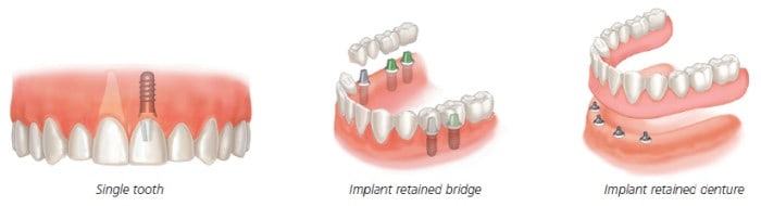Illustrative example of clear choice vs nuvia dental implants from Google Search