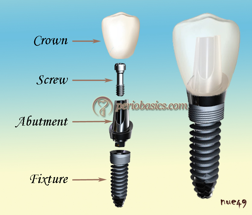 Illustrative example of components of dental implants from Google Search