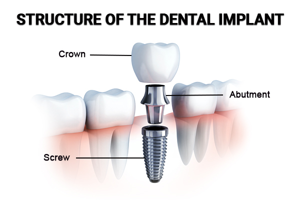 Illustrative example of components of dental implants from Google Search