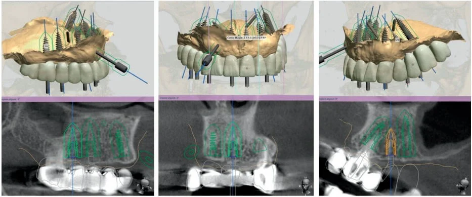 Illustrative example of cortex dental implants from Google Search