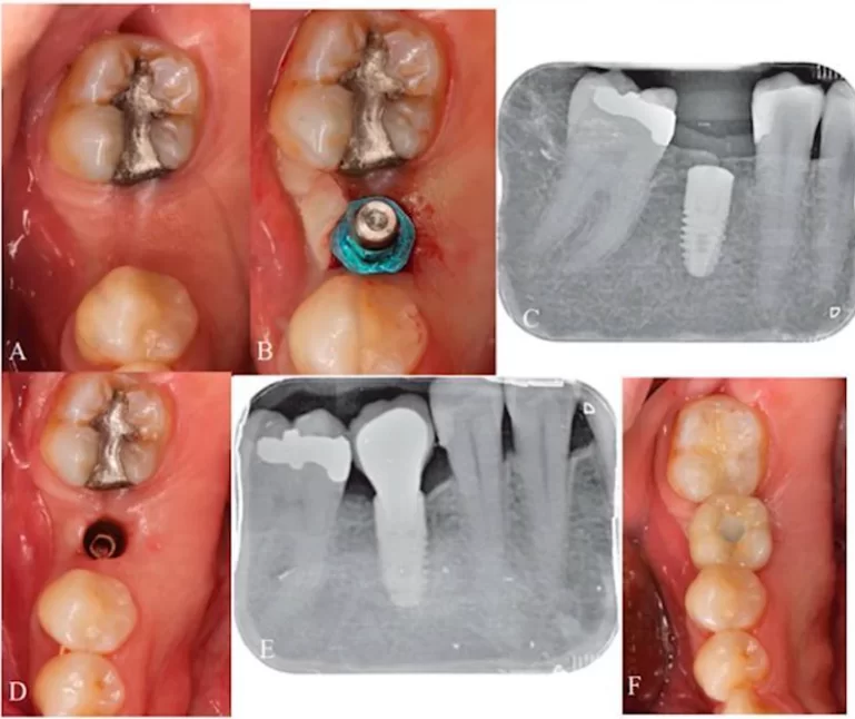 Illustrative example of cresta dental implants from Google Search