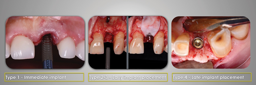Illustrative example of dental implant 10 years after extraction from Google Search